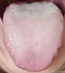 男人最怕舌根剥苔，调理起来那真不是一般的费劲！

患者症状：面色无华，口干口苦，