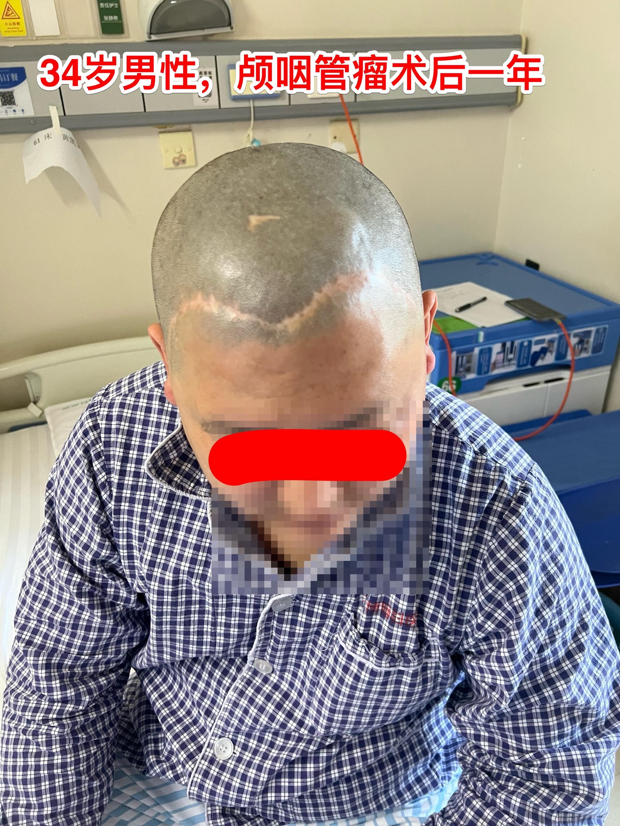 乳头型和造釉型颅咽管瘤的混合型存在吗？34岁男性，广东省惠州市人。一年...