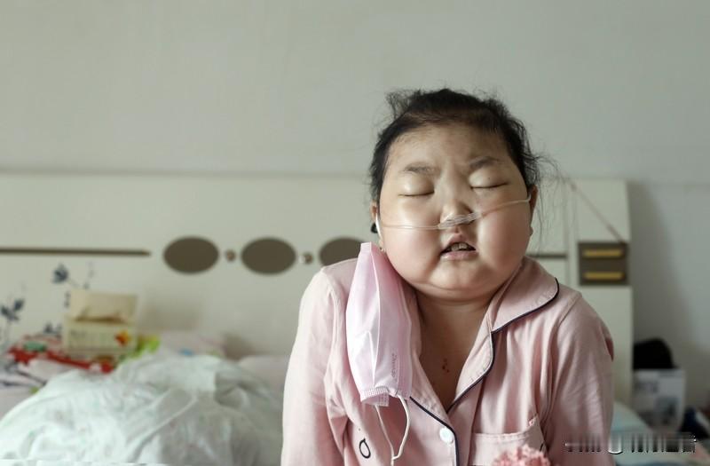 24岁女孩半年暴瘦50斤后突发面部浮肿，持续高烧查出尿毒症终末期。令人意外的是，