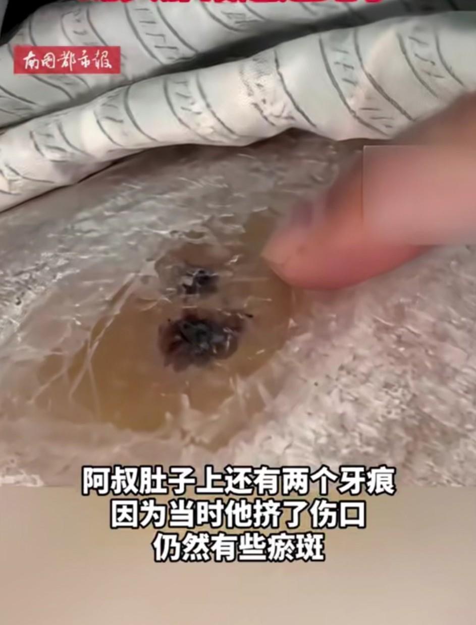 一位60岁的阿叔上山采茶时，肚子被竹叶青咬了一口！阿叔当即用剪刀把蛇剪成两段，不