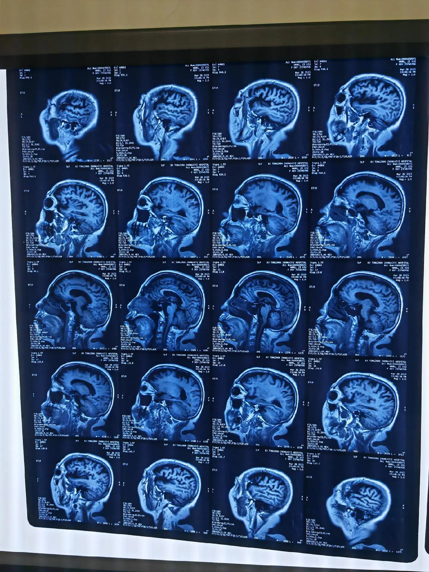 皮质基底节变性。