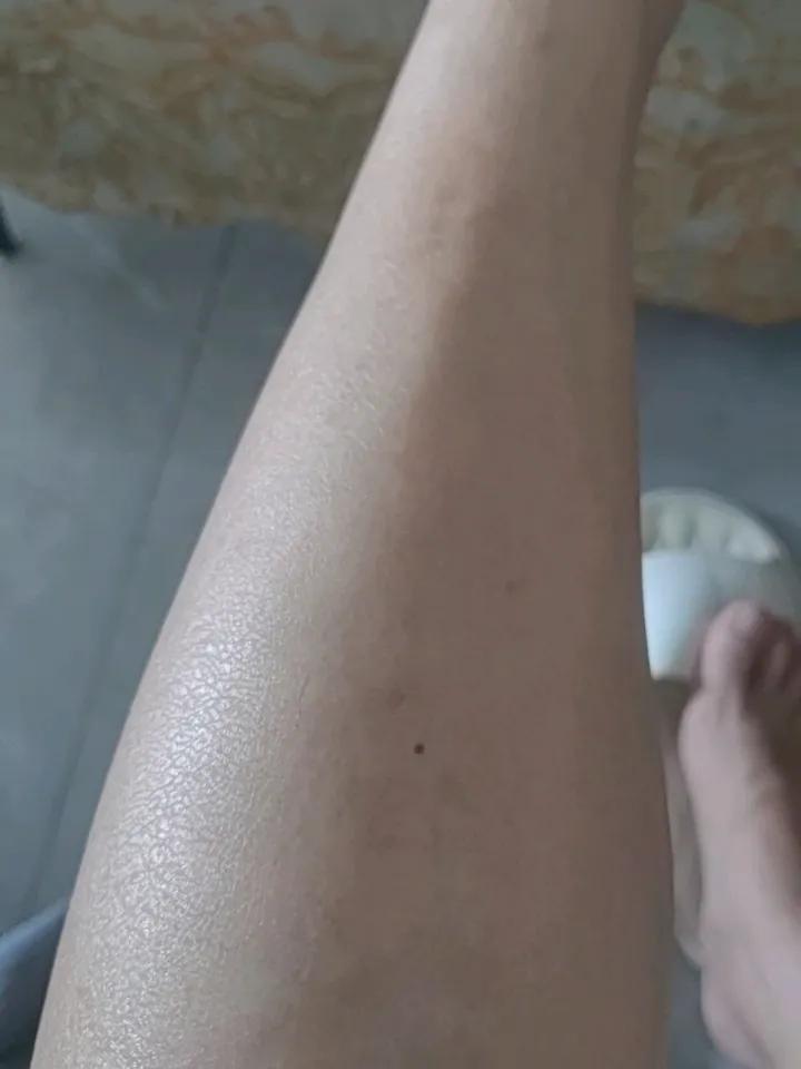 我向“蝙蝠侠”变化过程实录
今天是第三天，我发现腿上开始出现红色的斑点，胳膊上也