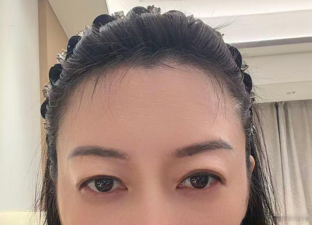 双眼皮修复第五天，明天就可以拆线了，眼尾那里修掉了一点松皮，目前看这次没有踩坑这