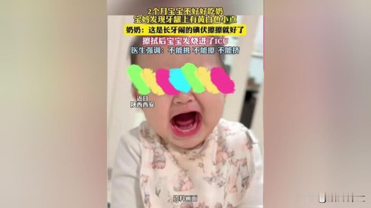2个月宝宝被奶奶碘伏擦进ICU

近日，西安2个月宝宝牙龈出现黄白色马牙，被奶奶