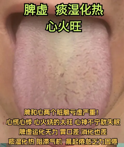 听从粉丝建议，周末不忙，来抽时间辨证！ 1.痰湿化热，脾肾两虚，有心火...