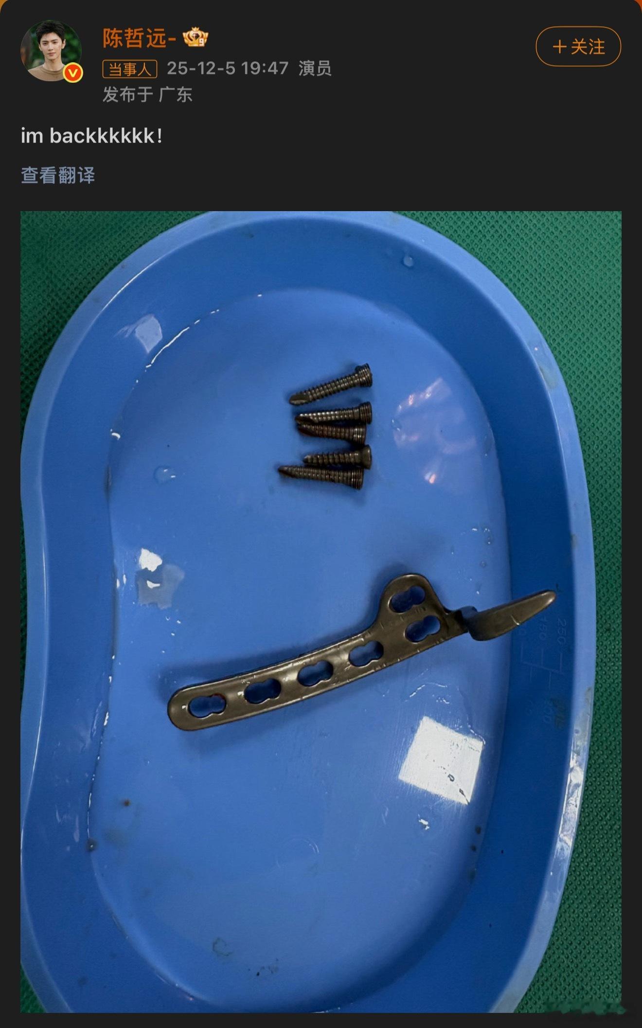 陈哲远晒手术取出的钢钉 好可怕😱 