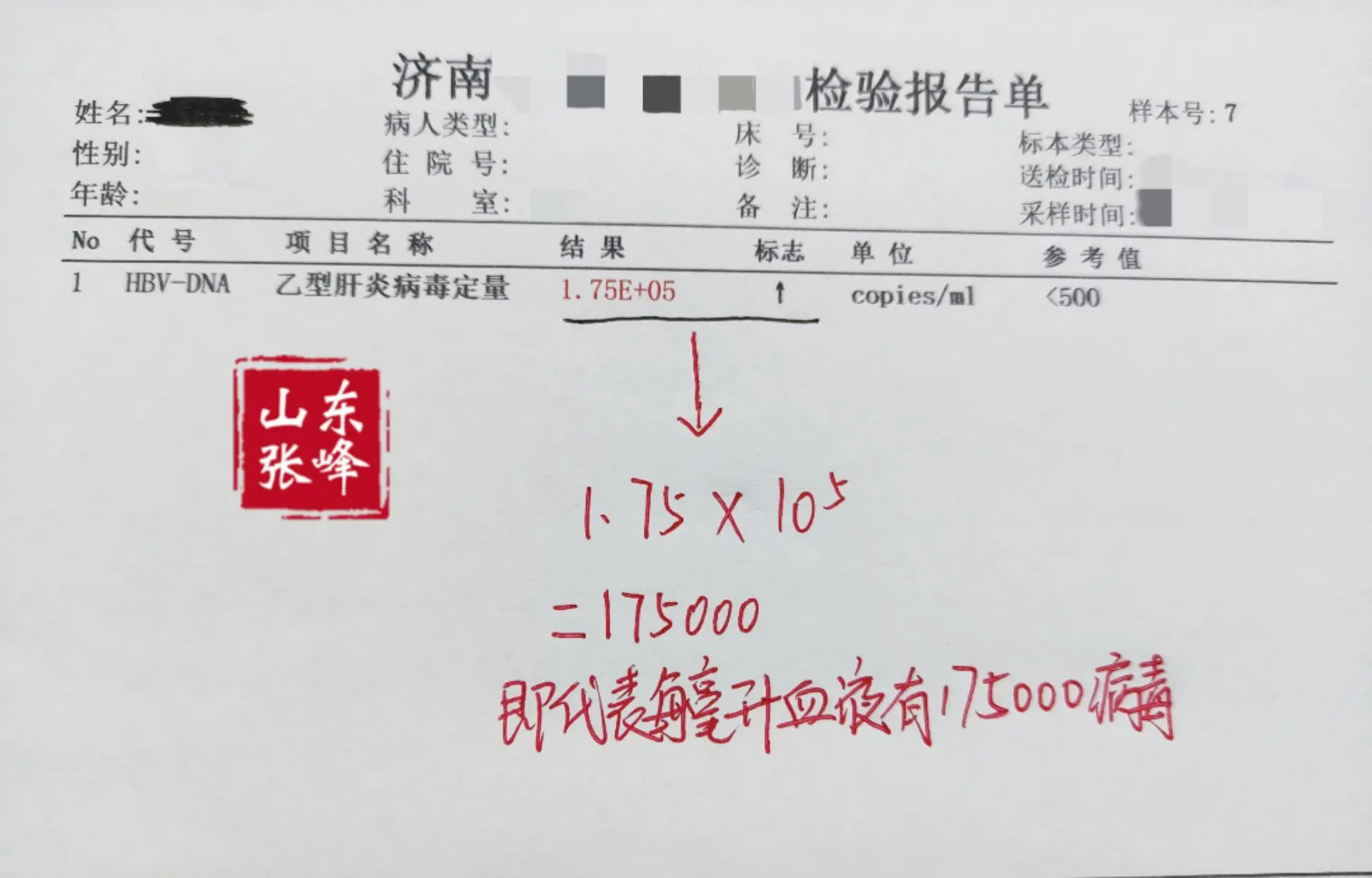 一位山东淄博的肝硬化患者，这次来检查病毒量5次方，抗病毒抗纤维化仍需继续！