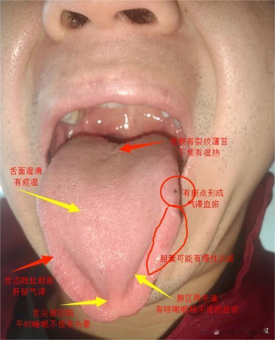 喉咙经常不舒服，老是想的多，一到晚上就睡不着[困][困]时间拖得久了就会成下面这