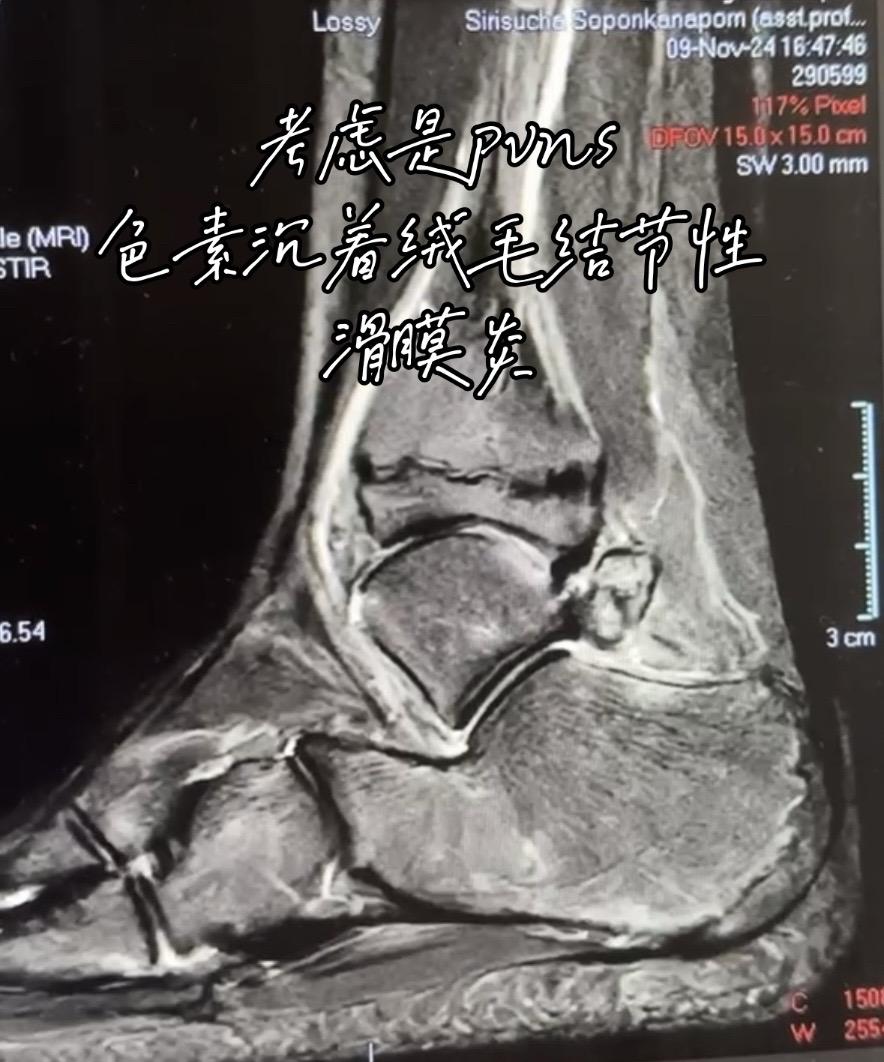 踝关节pvns较少见，还是尽早关节镜切除为好 踝关节色素沉着绒毛结节性滑膜炎