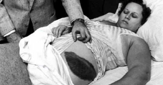 1954年，国外一女子正在睡觉中，突然感觉腹部和大腿被什么东西蹭着了一样，疼痛难