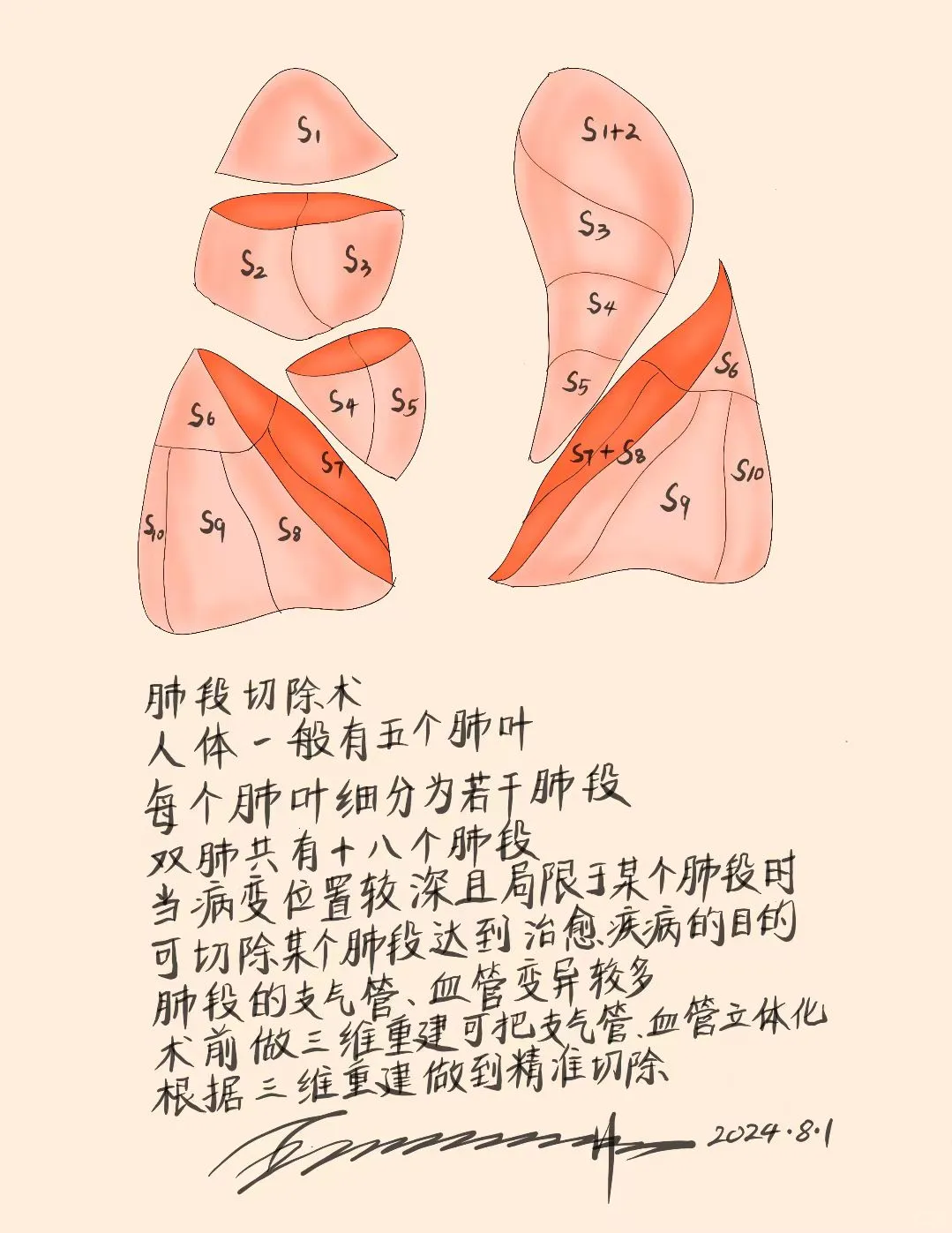 肺段切除术