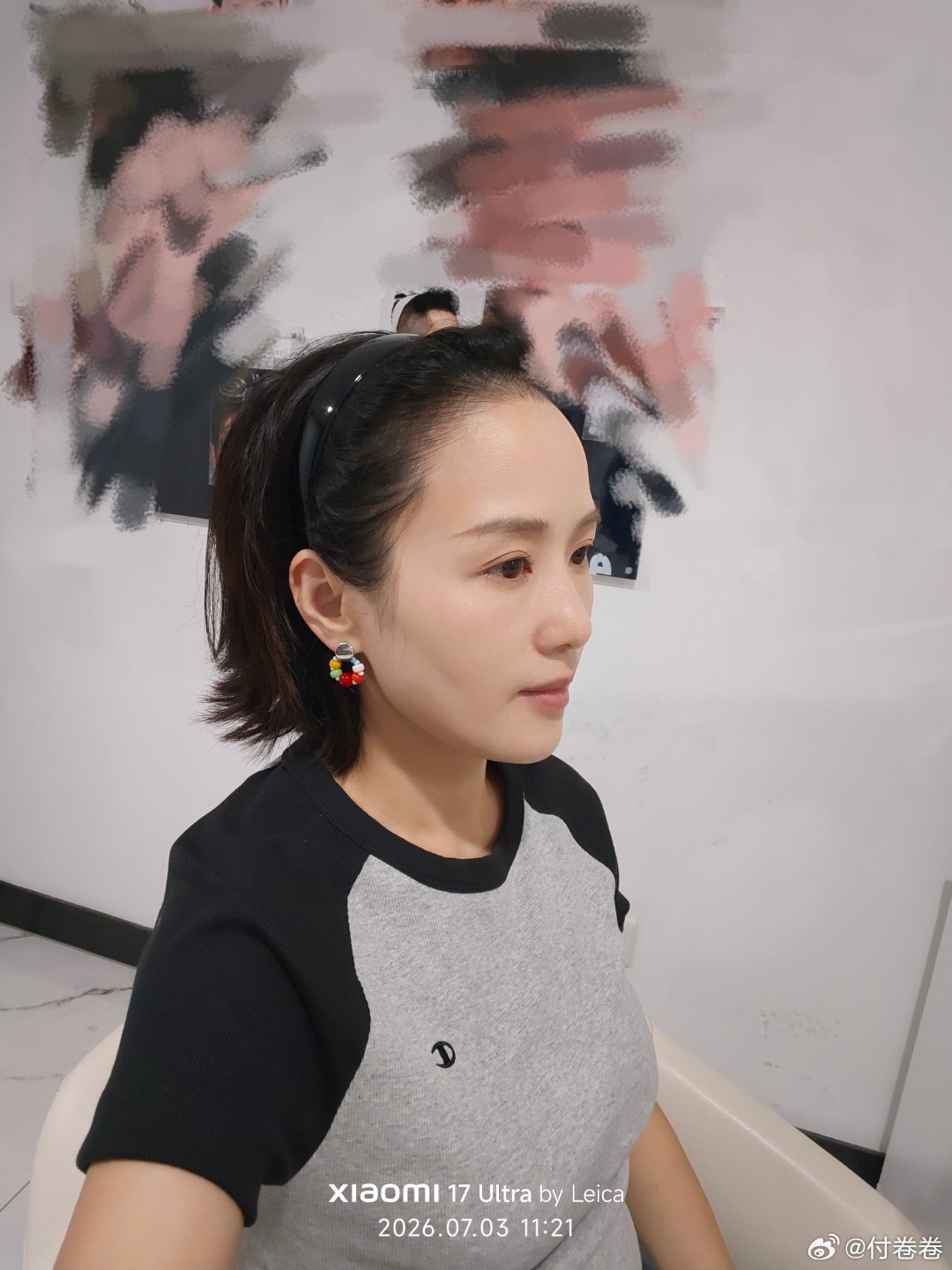 经常有人说我额头高，说我要在古代怎么也是个贝勒爷！我早上就去面诊植发了……图1是