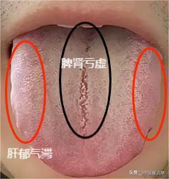 裂纹舌，厚腻苔，病根其实在肝，想调理的时候千万别大意

患者主诉：功能差、容易累