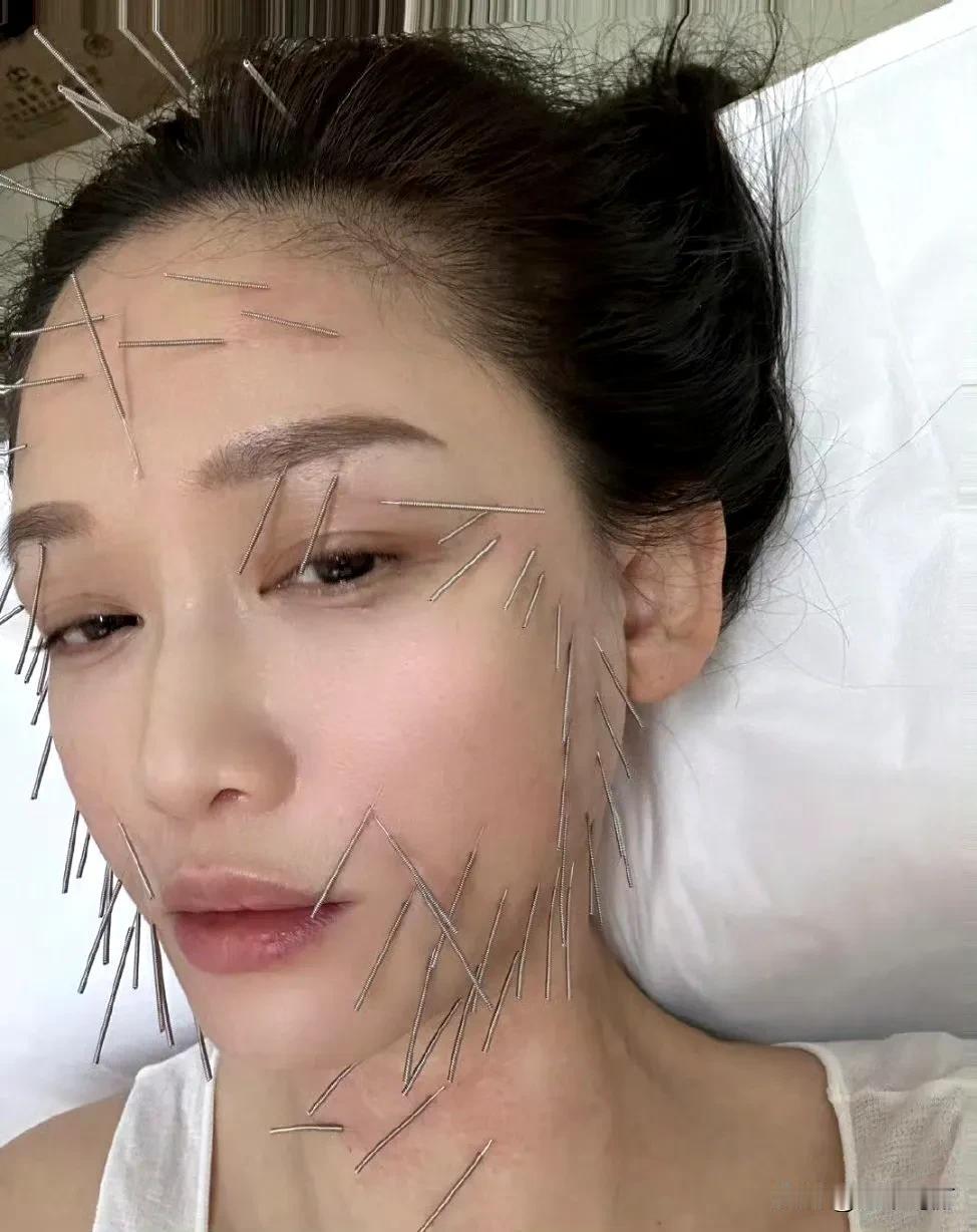 陈乔恩的保养方法，难怪女明星们这么美，不是谁都敢受十大酷刑的[捂脸]
这种扎穴位