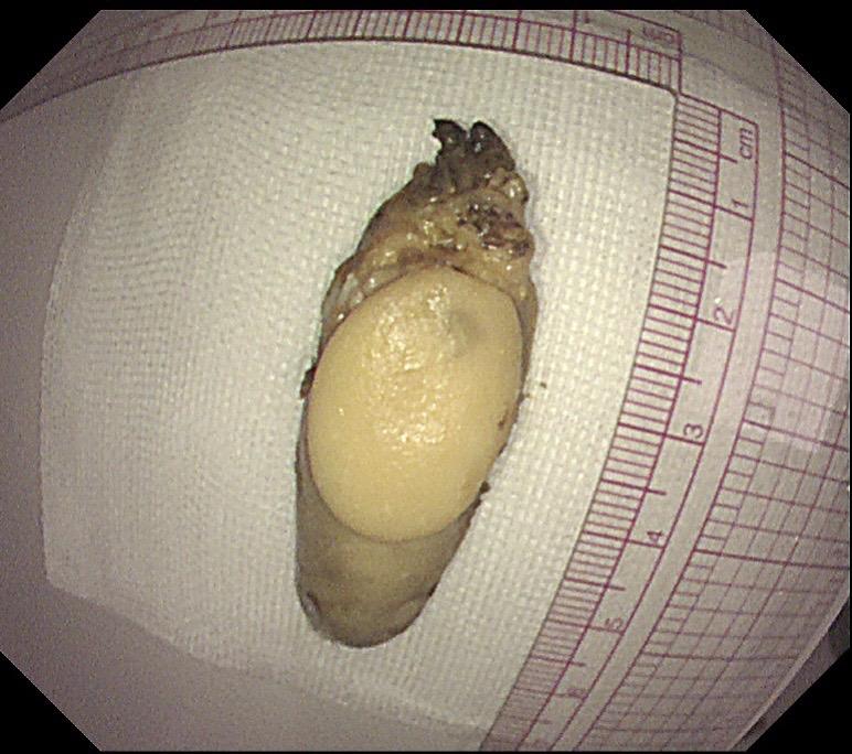 老年人吞咽不畅必有妖！老年人被鲍鱼卡住，做胃镜之前就怀疑是不好的病，胃...