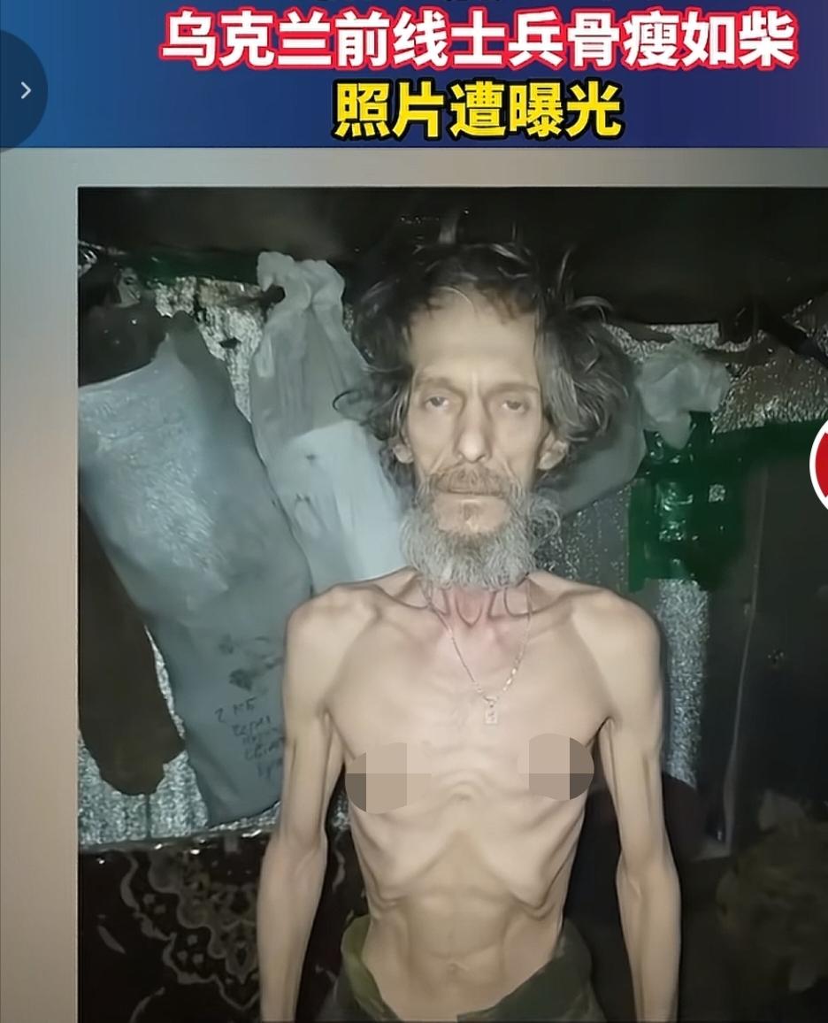 乌克兰的前线士兵太难了，都被饿成皮包骨了。通过媒体发出来的照片清晰看到，这些被断