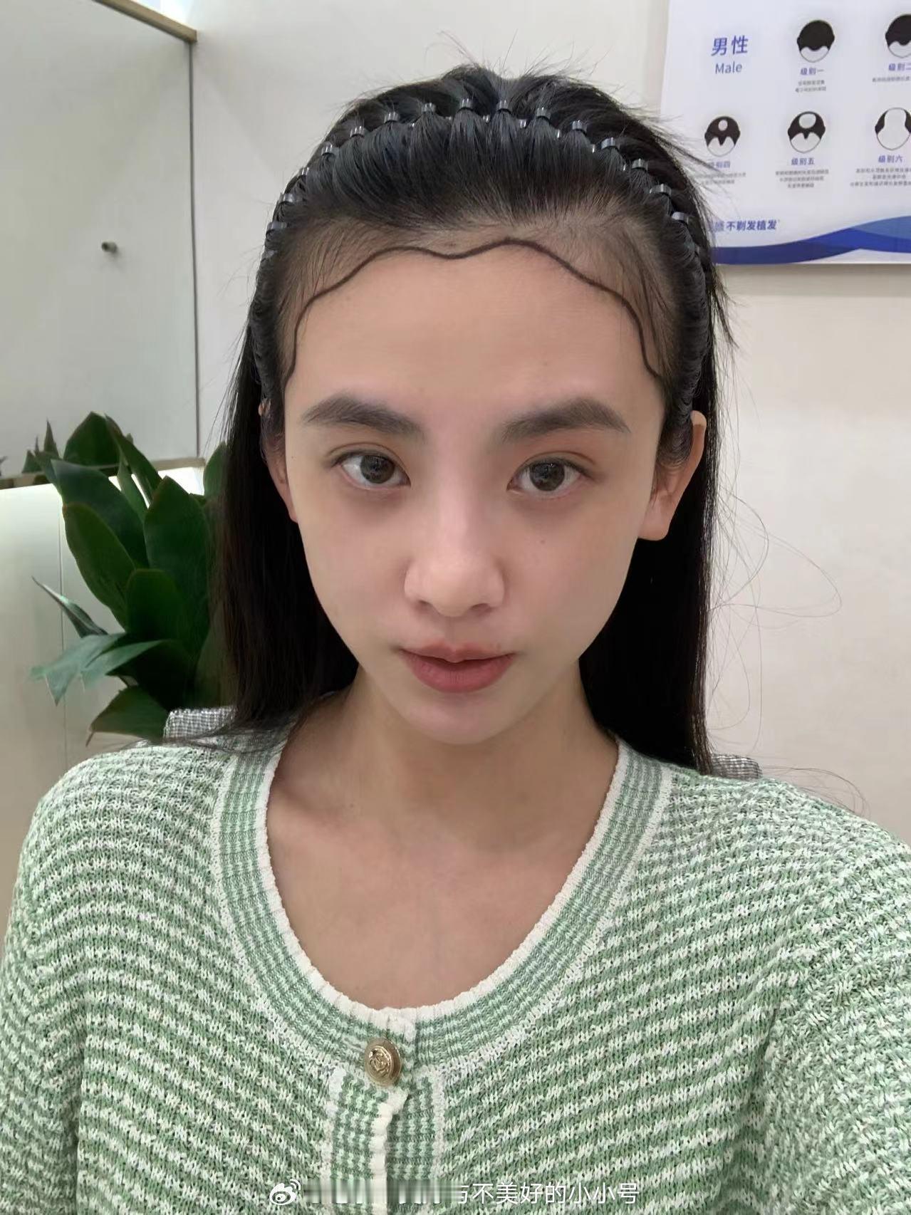 前几天赞助了婕宝去植发，给大家看看现在的恢复情况[可爱]今天已经是第7天了。说真