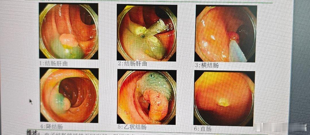 图二息肉里面居然有个腺癌，所以，任何小病种都是大学问，精准评估和选择手术方案很重
