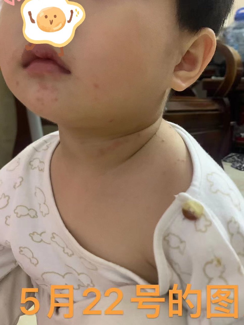 #宝妈咨询# 健康群广东汕头宝妈：小宝2岁，5月22号发烧，全身开始起一颗颗不知