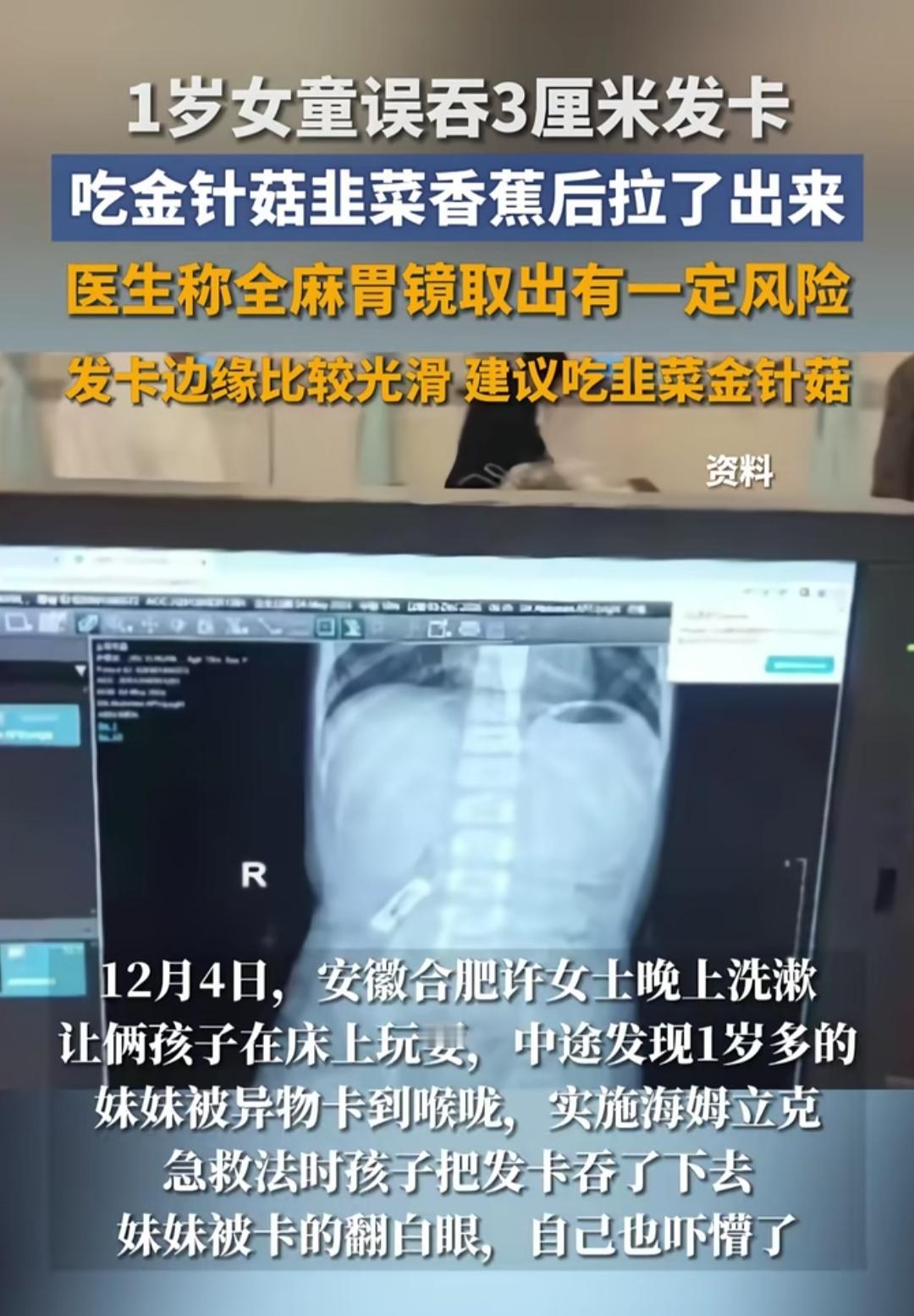 1岁女童误吞3厘米长的发卡，全家急得团团转！送医后医生没让立刻手术，反而建议多吃