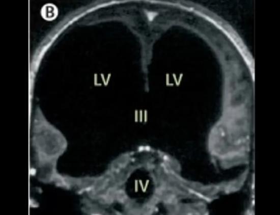 2007年，法国出现了一个让人震惊的案例，一名男子在做脑部检查时，医生竟然发现他