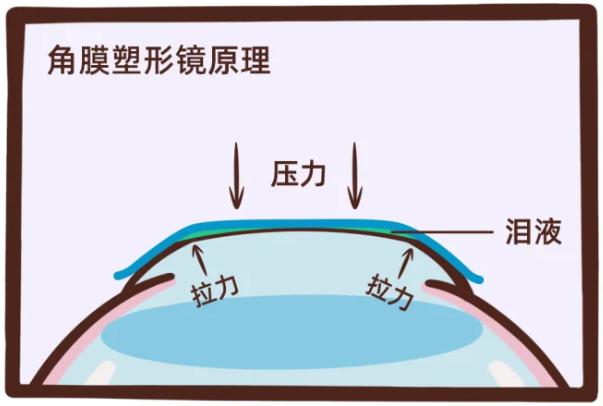 你的娃是怎样控制近视的，是否应用过角膜塑形镜，了解下？？？