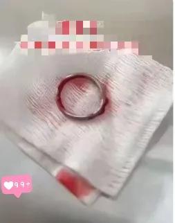 我离婚后的第一件事就是去医院取避孕环，戴了十年的避孕环一直没取，一直都觉得没事就