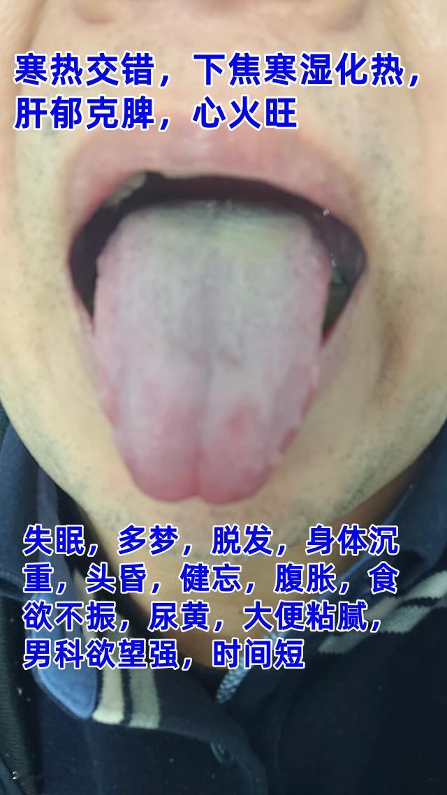 公益舌诊，今天继续，这会不忙，抽空继续来帮大家分析舌象：

1.寒热交错，下焦寒
