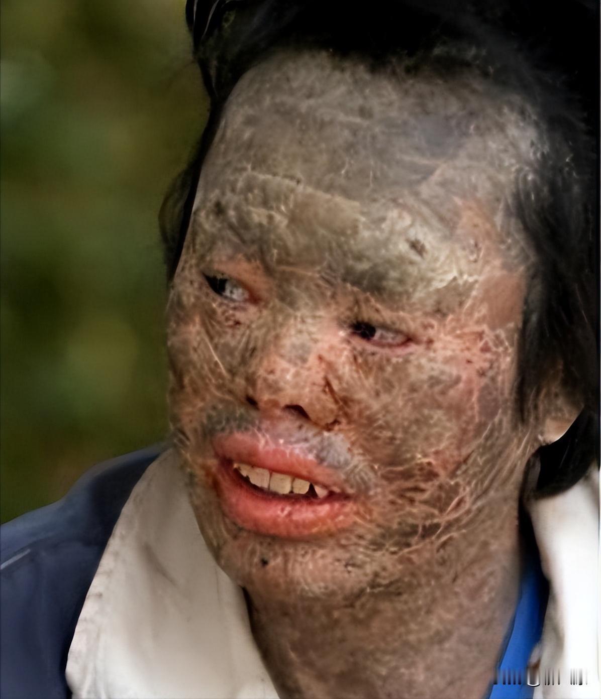 [微笑]2016年，一男子晚上吃了一条蛇，第二天皮肤竟开始溃烂，长出“蛇皮”，医