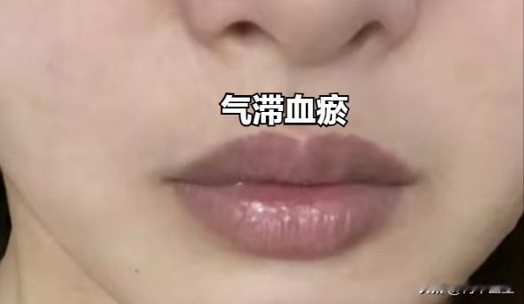 嘴唇颜色深可要当心，可能是气血瘀滞了

中医上讲“脾开窍于口，唇为脾之外容”口唇