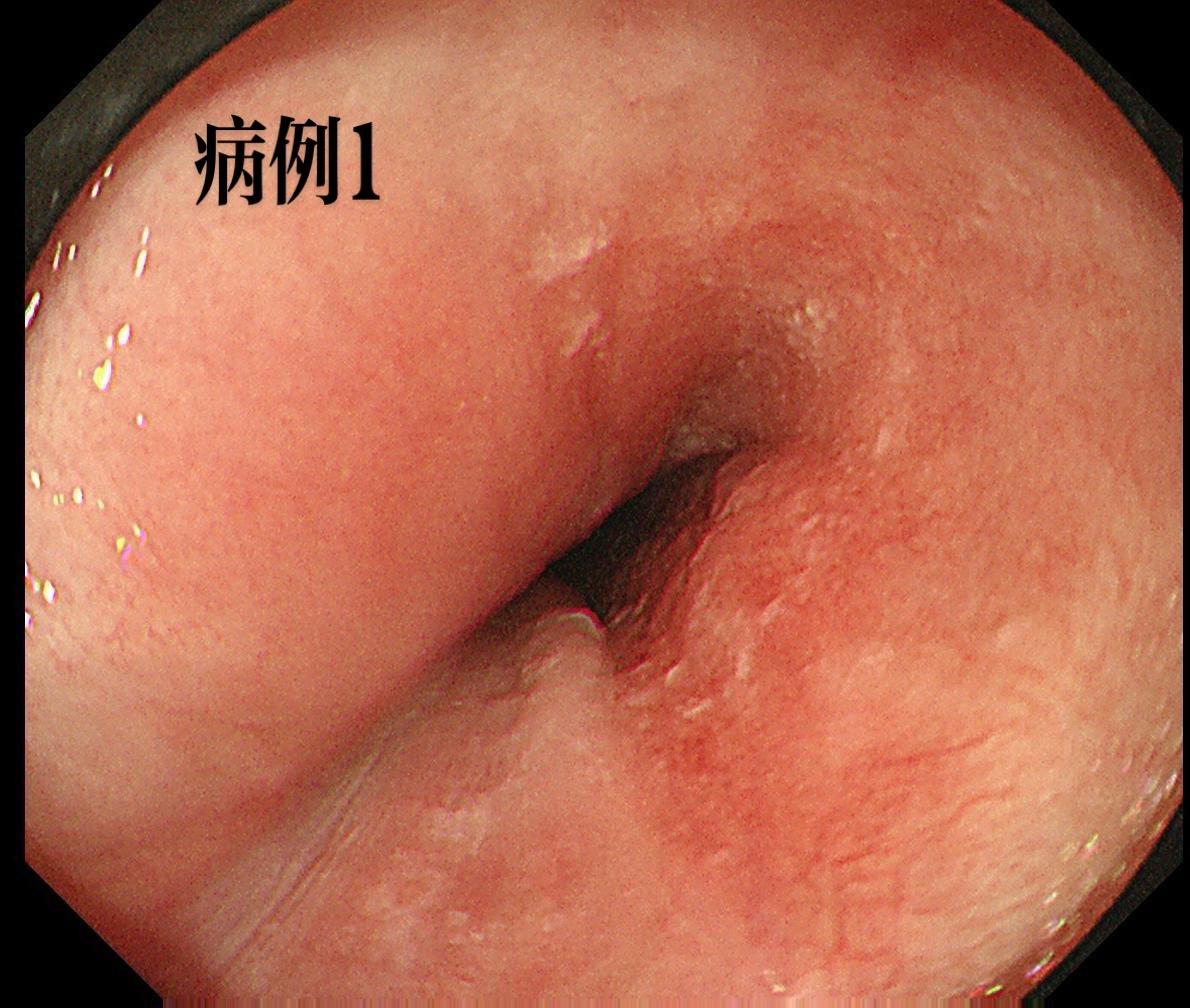 食管ESD术后再发病例。早癌的内镜治疗从来都不应该是一锤子买卖，规律的...