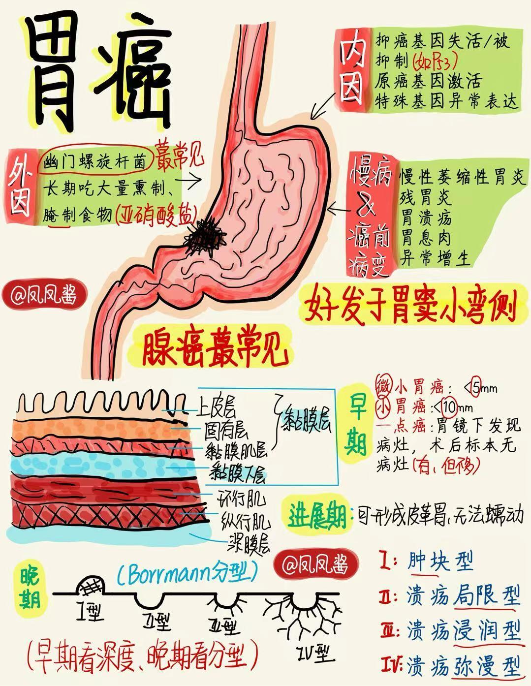 📖医学生笔记｜胃癌 建议点赞收藏🔥