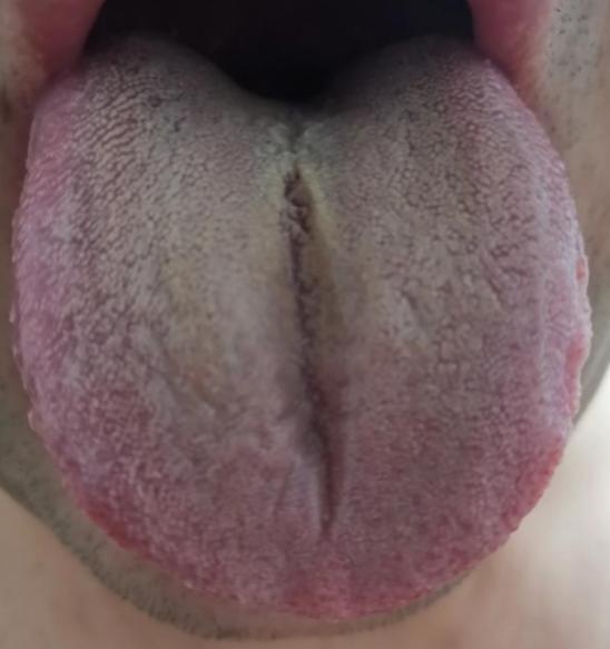大哥你看看自己舌头啥样了，还敢把全部希望放在补肾上！真是头疼！
 
最怕遇见这样