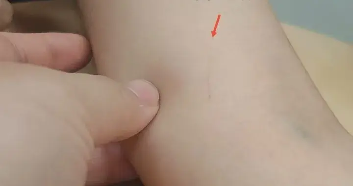 19岁女孩回老家抱了一下猫，三天后肘部突然长出包块，腋窝淋巴结肿大，父母以为是恶性肿瘤……医生：一年