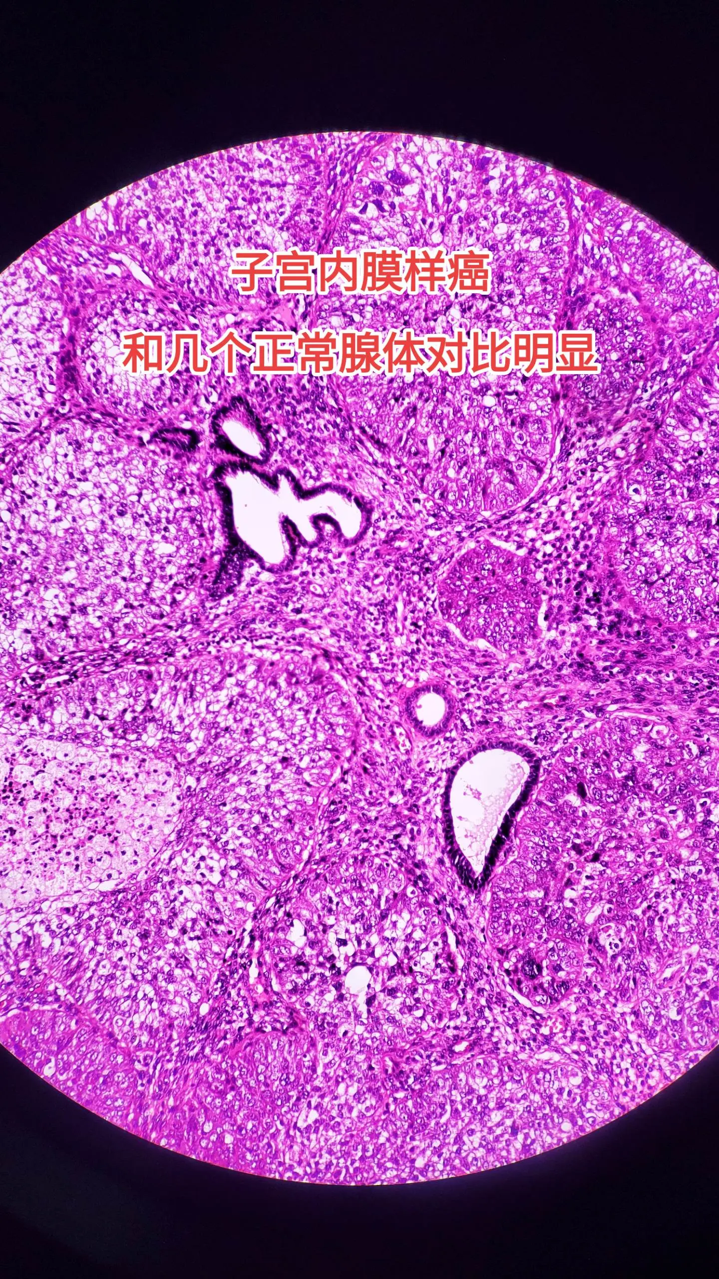 子宫内膜癌