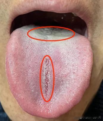 粉丝腰膝酸软，肾气虚，吃金匮肾气丸没用，原因就在舌头上
这位粉丝平时经常腰膝酸软