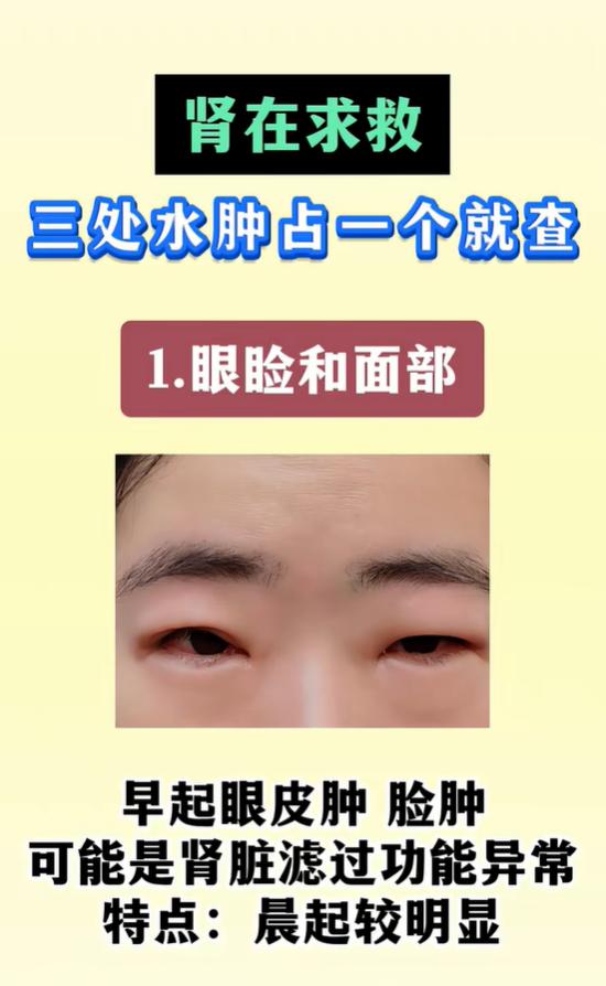 肾脏发出的预警：三种水肿表现，出现其一建议就医