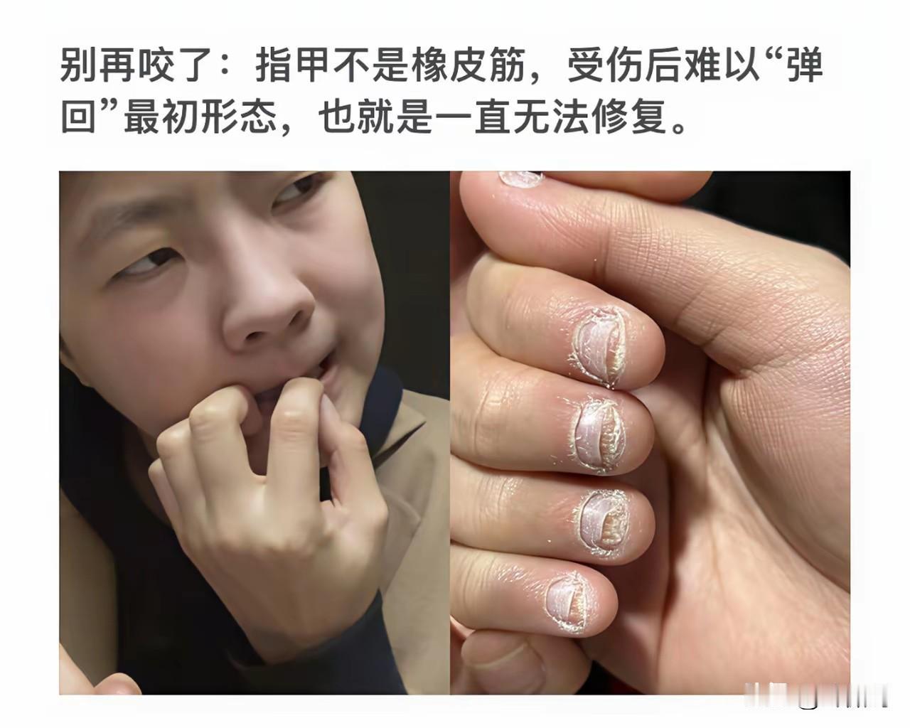 以前一个同事，经常这样咬食指，看他一小块指头都咬没了。

都劝他别啃了，他说忍不