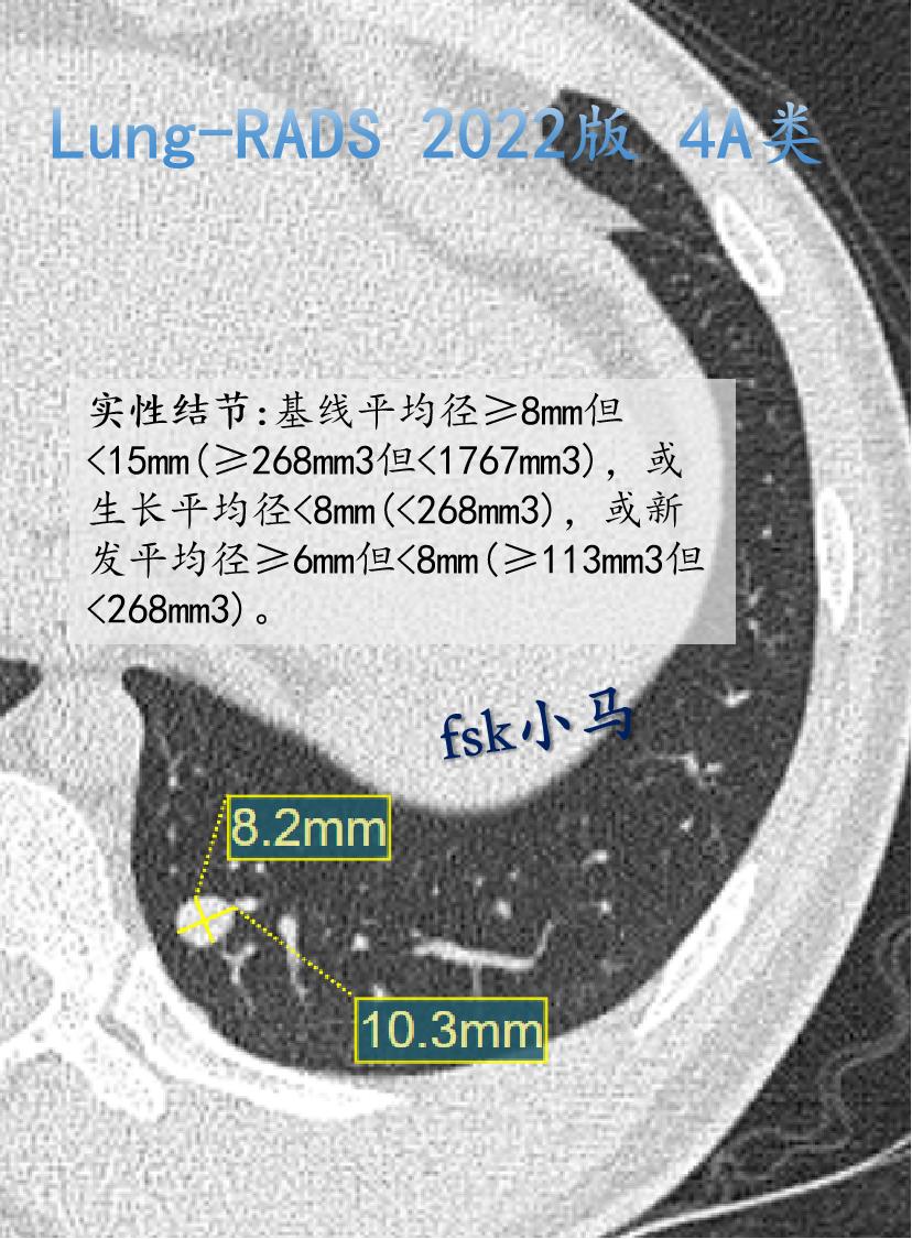 Lung-RADS 2022版 4A类：可能良性，群体罹患率9%。表现...