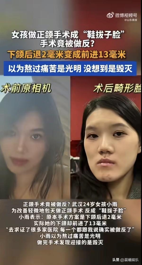 太离谱！微调2毫米的小手术，医生直接做反方向！武汉24岁女孩彻底崩溃，好好的脸蛋