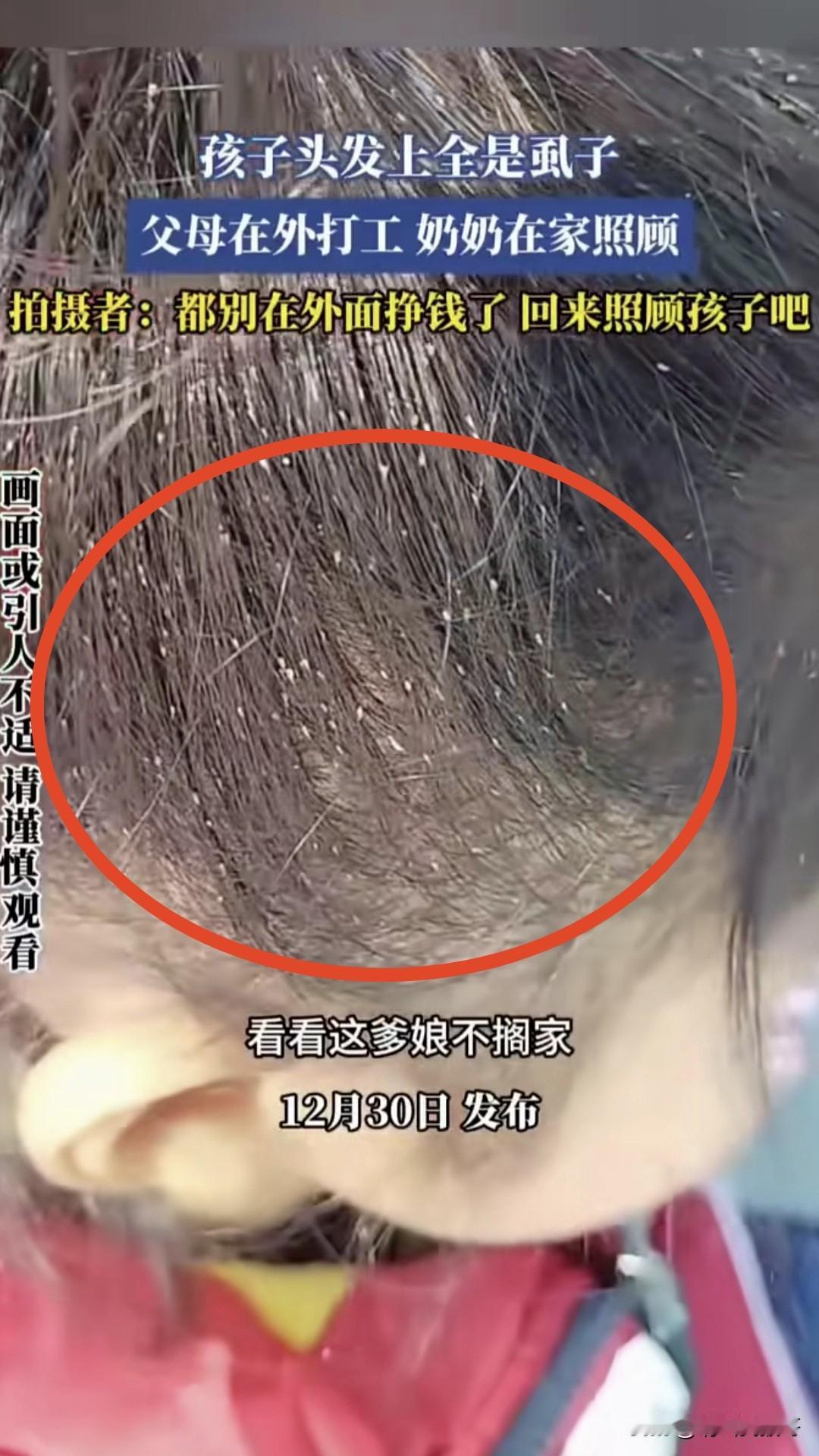 谁能想到这个小女孩满头长满了虱子，却无人问津，只因父母在外打工，仅一个年迈的奶奶