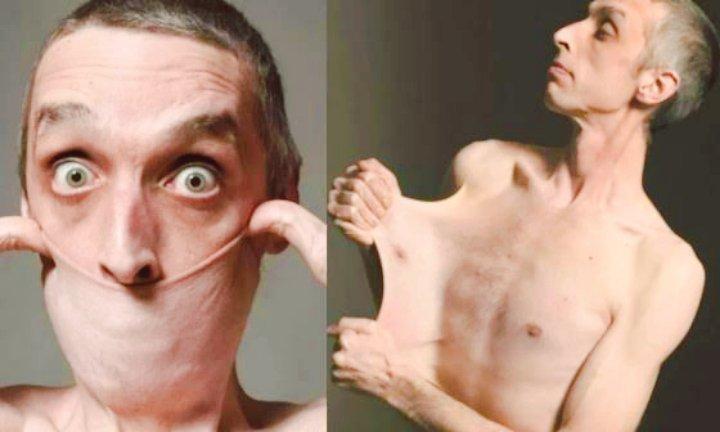 Ehlers-Danlos 综合征 (EDS)：具有遗传性的一组异质结缔组织疾病