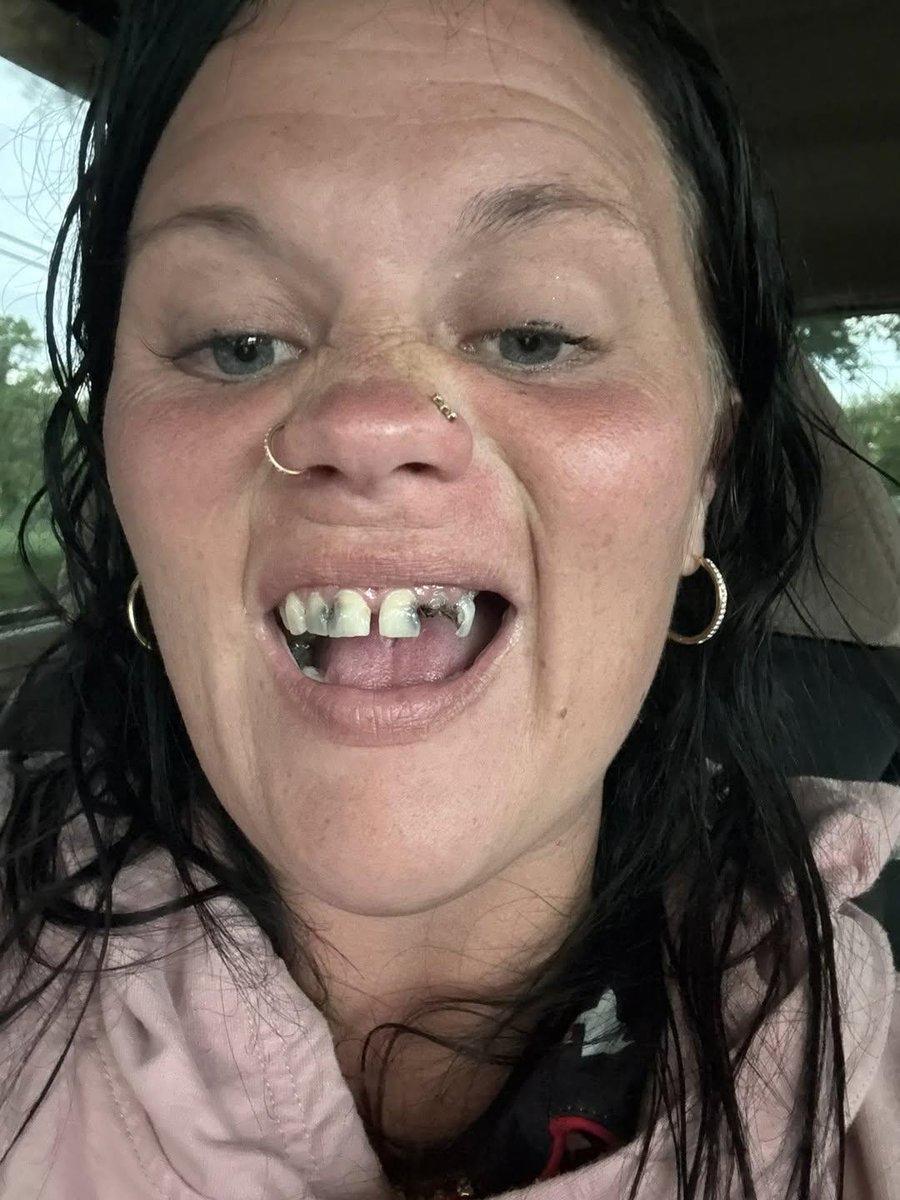 一名美国妇女做了牙齿，更爱笑了。外国女性  牙齿整牙 女星整牙 牙科老阿姨 女生