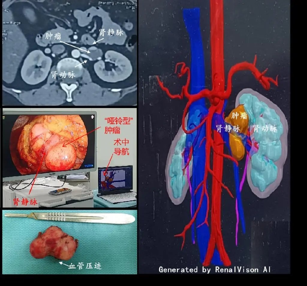 腹膜后肿瘤，位于左肾肾蒂，被肾动脉、肾静脉、腹主动脉紧密包绕，并将左肾静脉拉长、