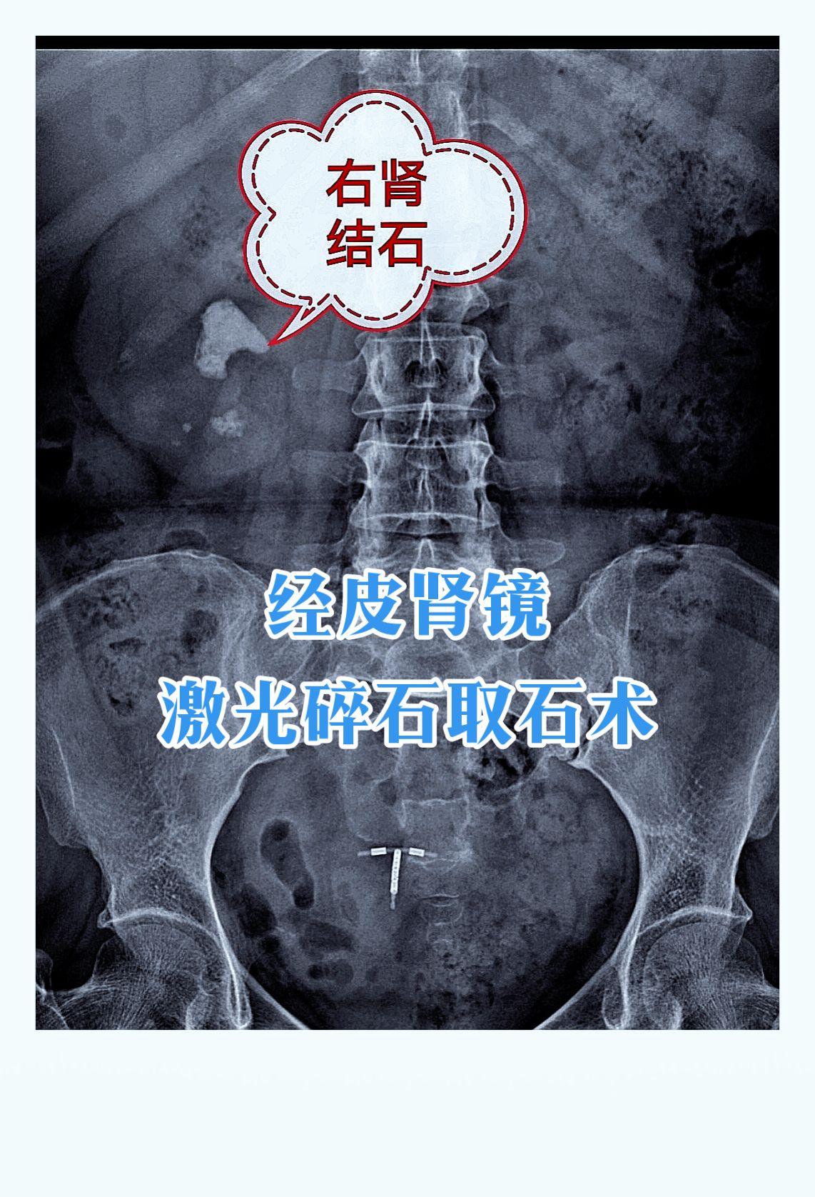 “钻孔取石”：一文读懂经皮肾镜取石术。您或您的家人是否正在为肾脏里的...