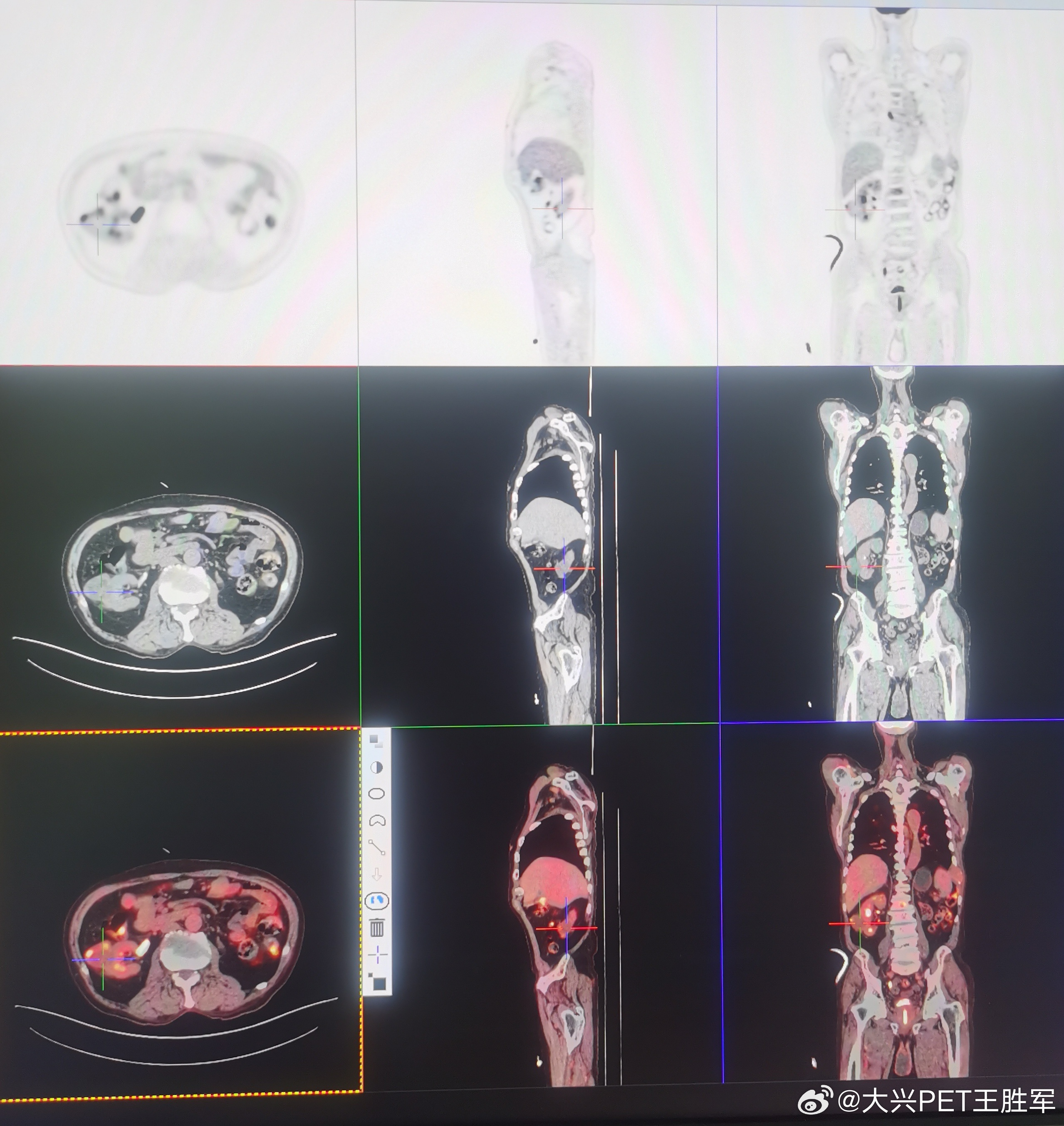 PET/CT比常规CT和核磁共振的优势在于全身无间断连续显像，发现肿瘤更全面，有