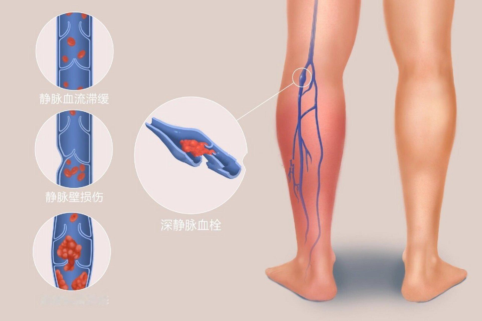 文班亚马赛季报销  深静脉血栓(DVT)是一种血液在深静脉内异常凝结形成血栓的疾