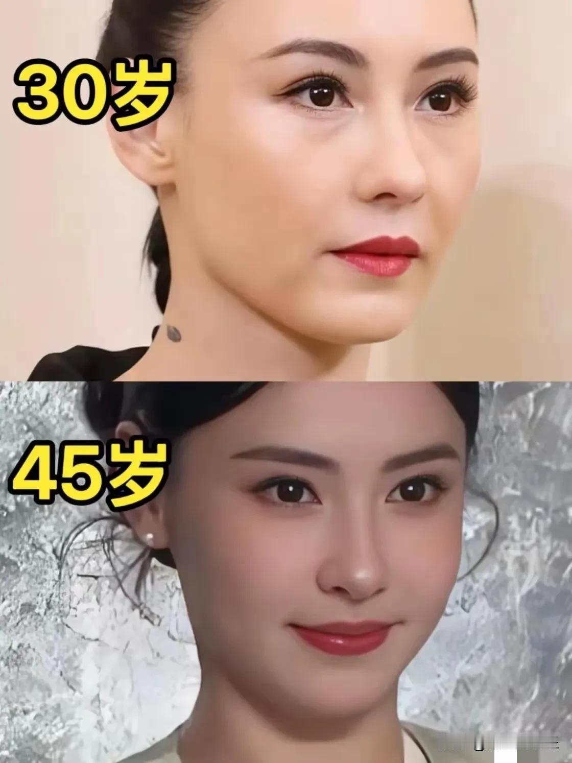 张柏芝这算是微调届“天花板”了吧？
真是妥妥的“逆生长”啊！
面部填充后整张脸都