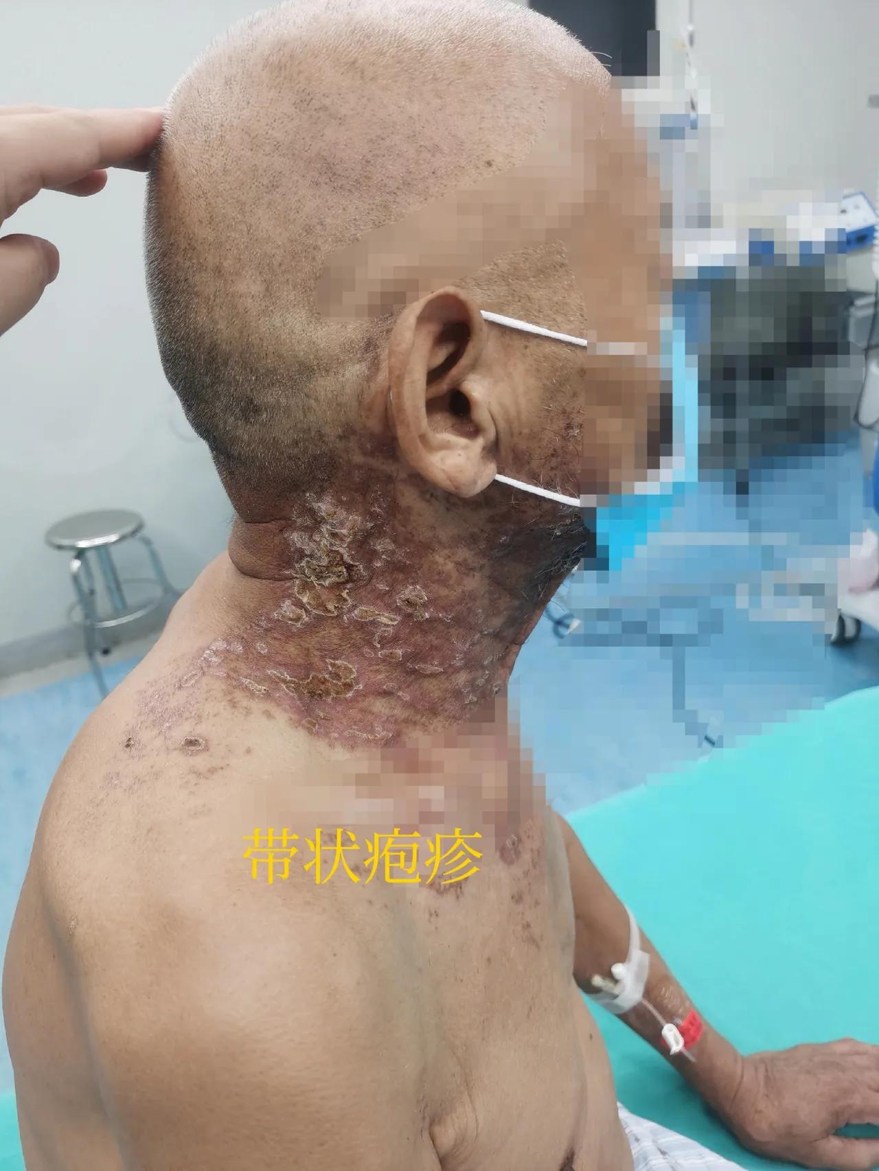 免疫力低更易反复