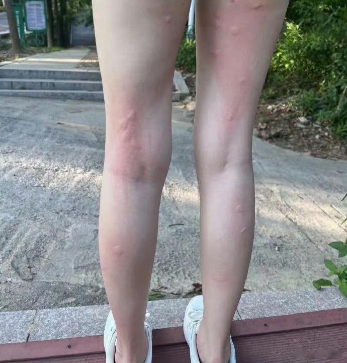 网友:腿上长了大疙瘩，又疼又痒，我该怎么办 ​​​